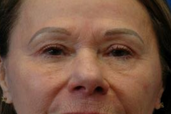 Brow lift — after