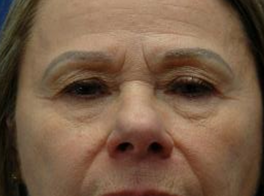 Brow lift — before