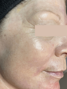 CO₂ laser resurfacing — after