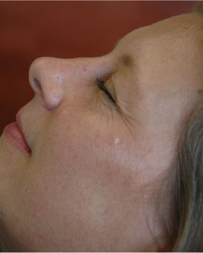 CO₂ laser resurfacing — Case 2, after