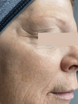 CO₂ laser resurfacing — before