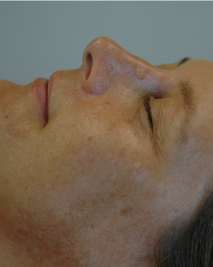 CO₂ laser resurfacing — Case 2, before