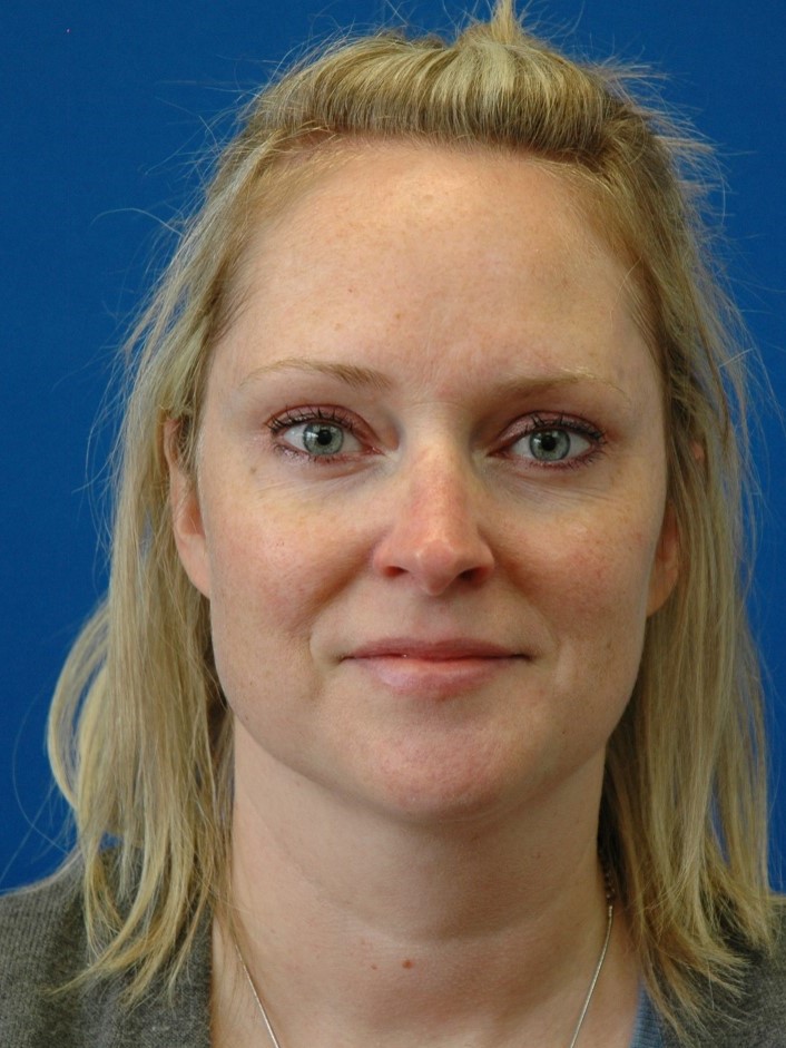 CoolPeel — before