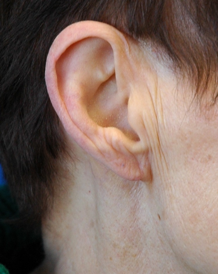 Torn ear lobe repair — after