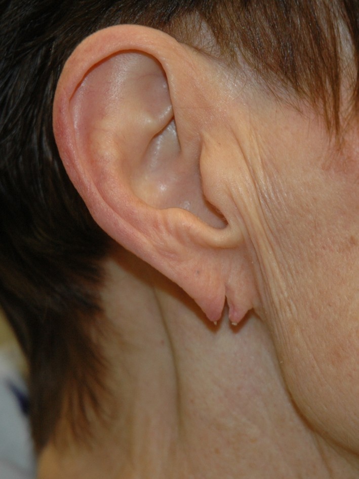 Torn ear lobe repair — before