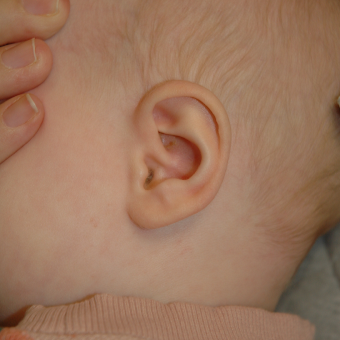Otoplasty (ear surgery) — after