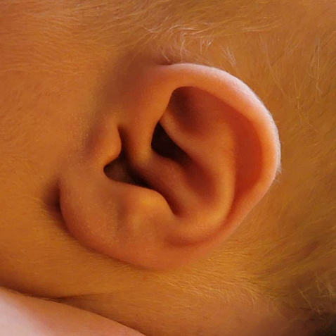 Otoplasty (ear surgery) — before