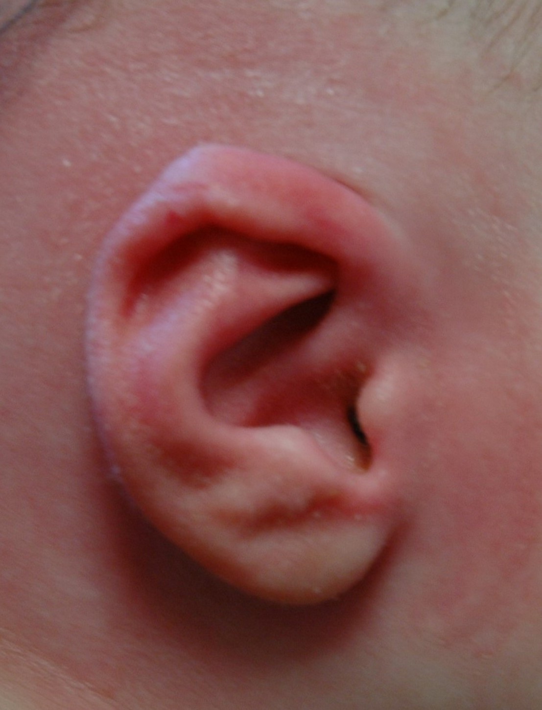 EarWell infant ear molding — after
