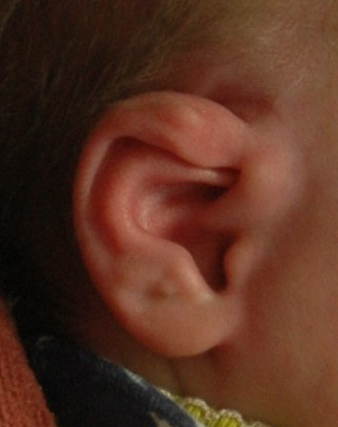 EarWell infant ear molding — before