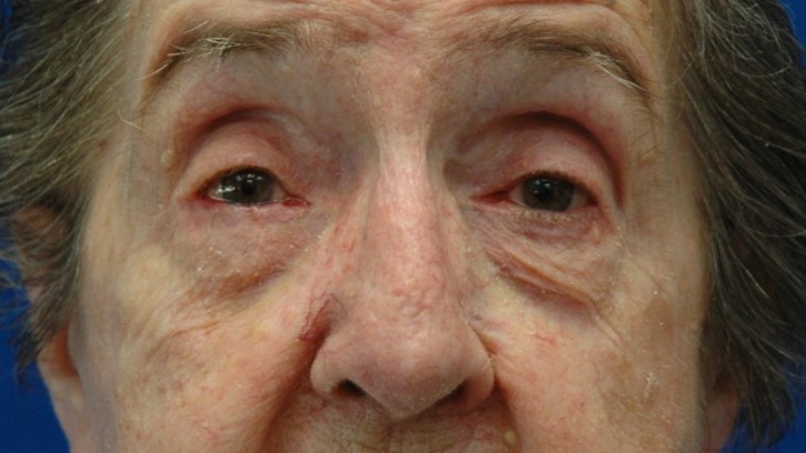 Eyelid reconstruction — after