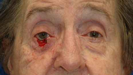Eyelid reconstruction — before