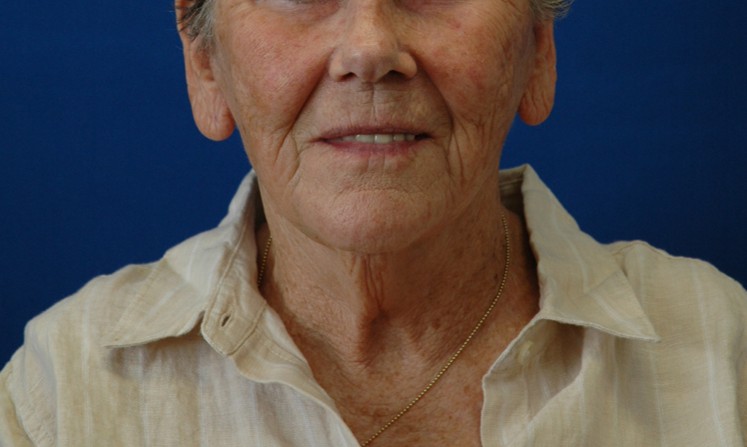 Facelift — after