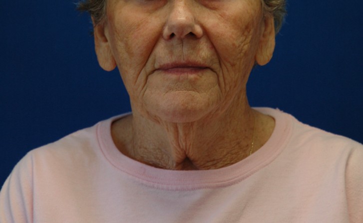 Facelift — before