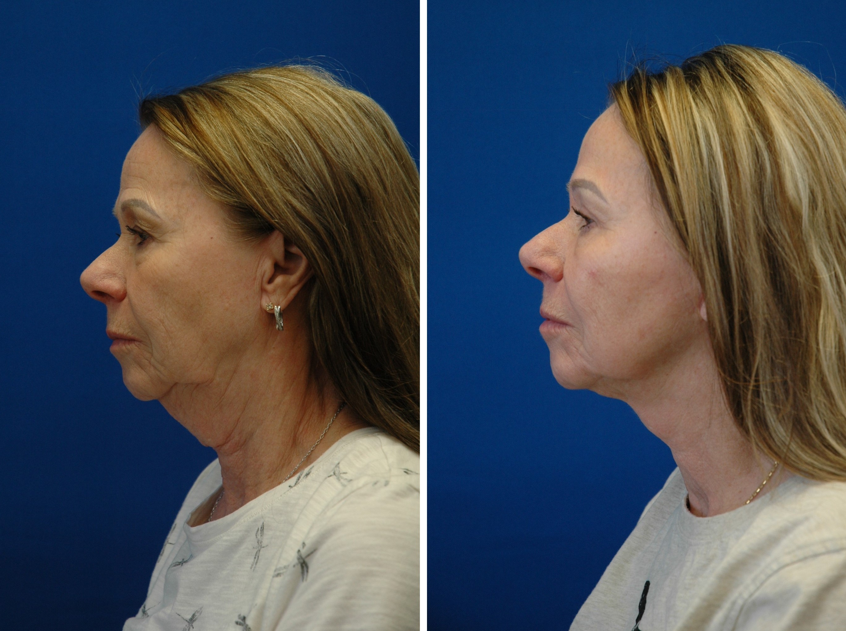 Facelift — lateral view (together), second set