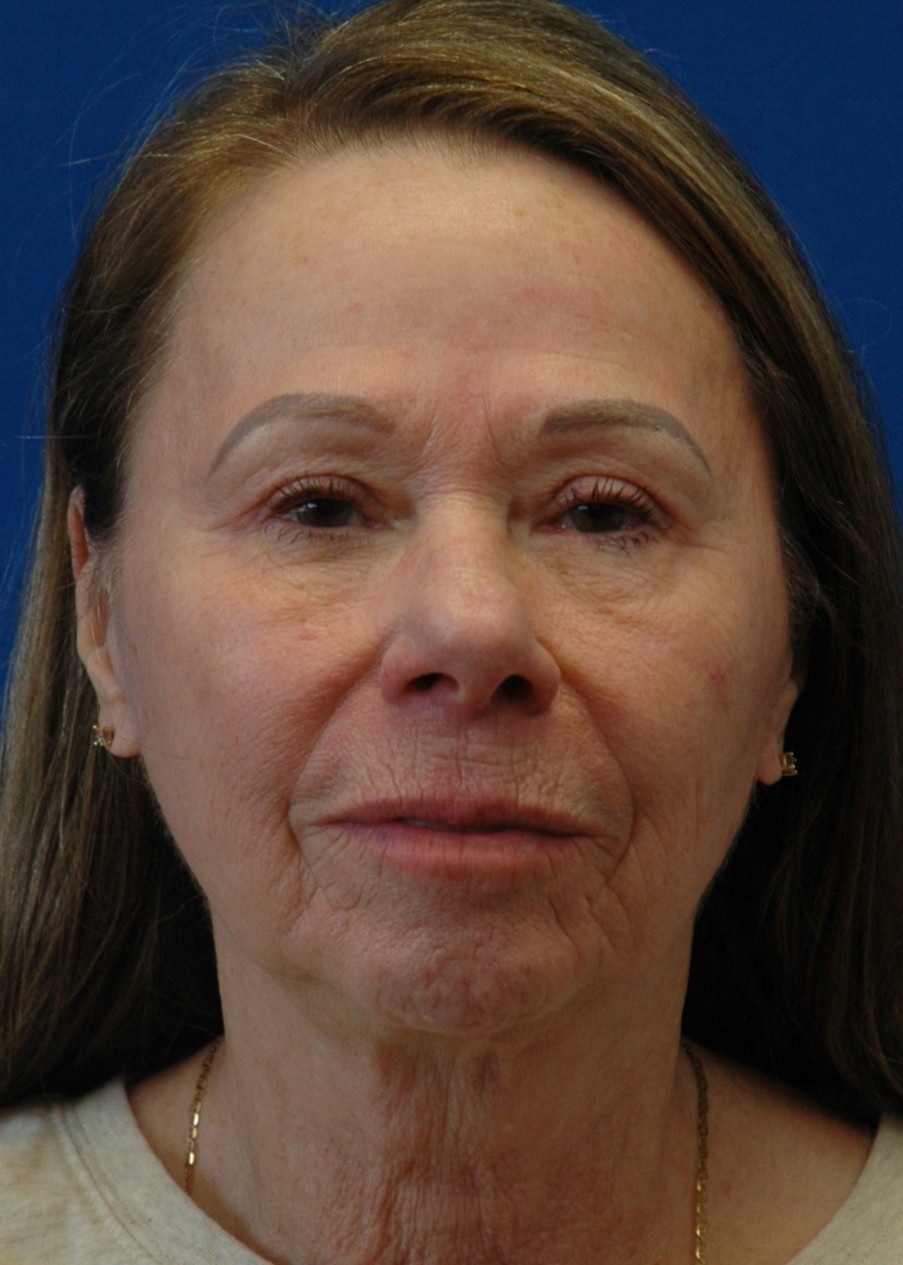 Facelift — after