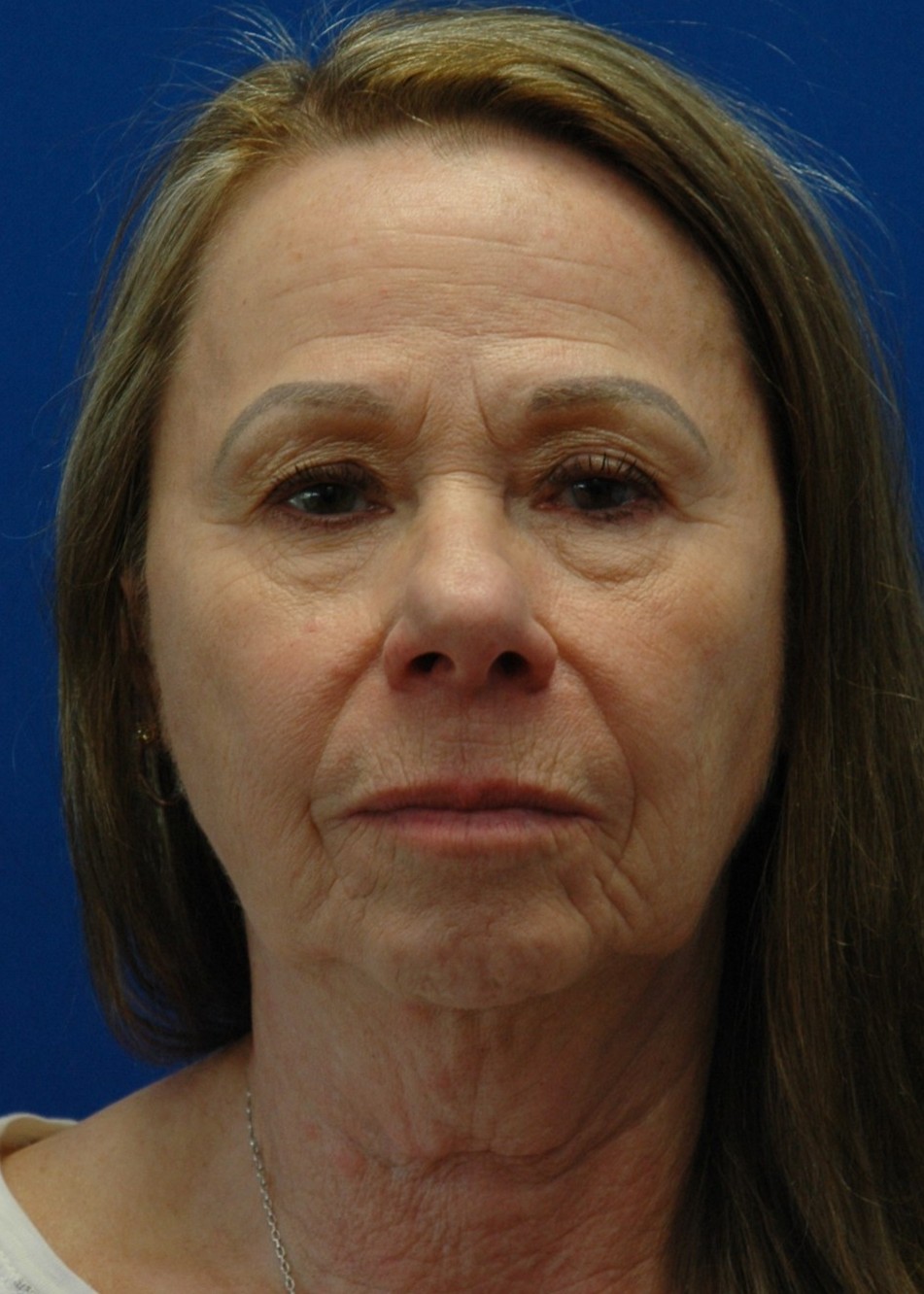 Facelift — before