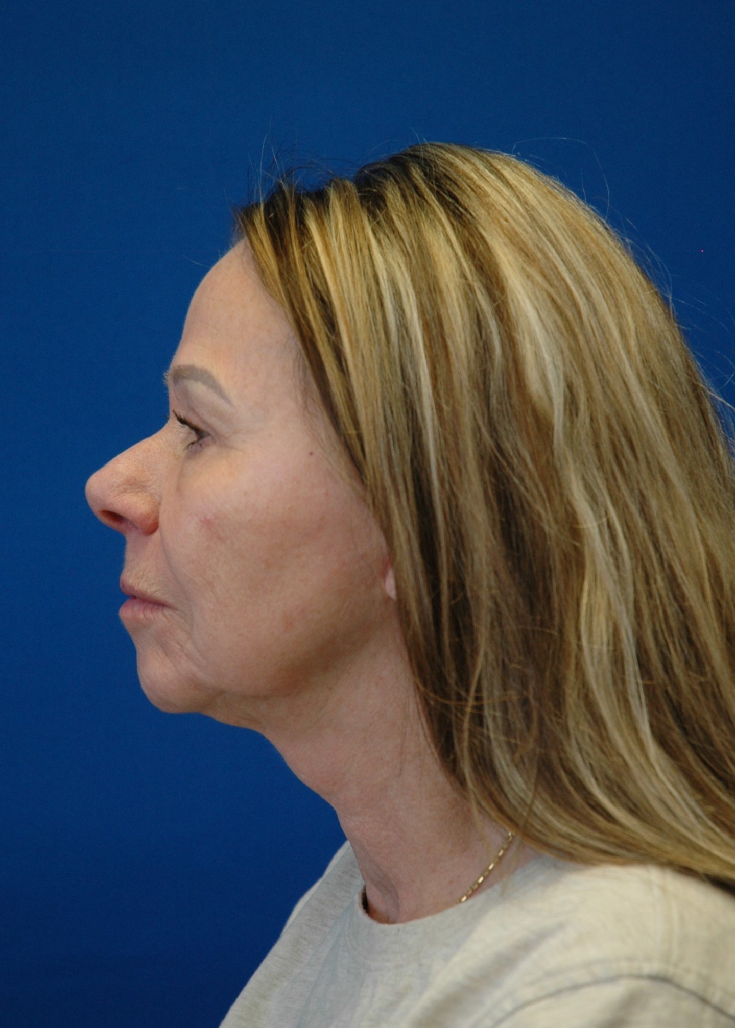 Facelift — after