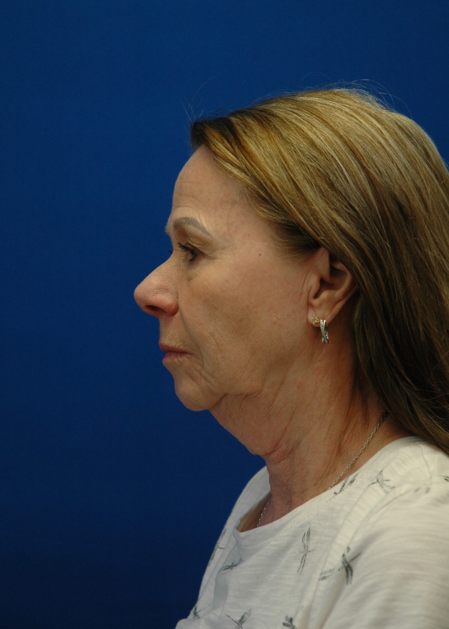 Facelift — before