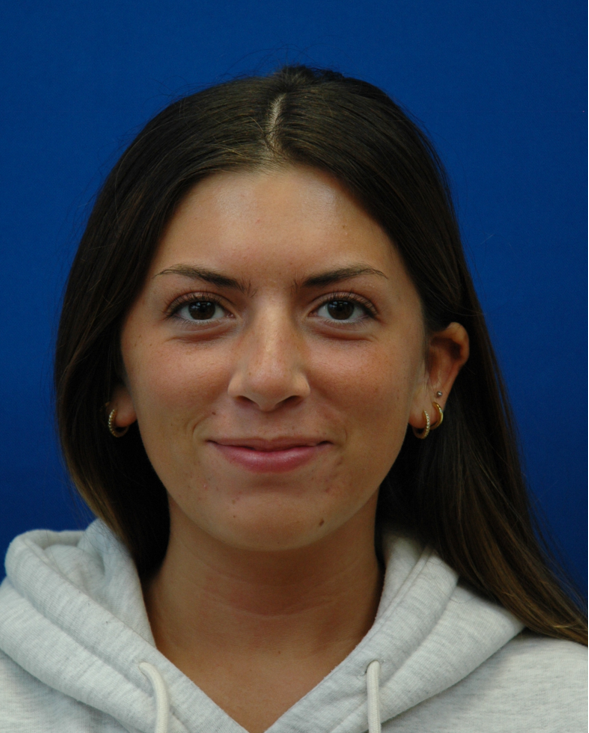 Chin implant — frontal view, after