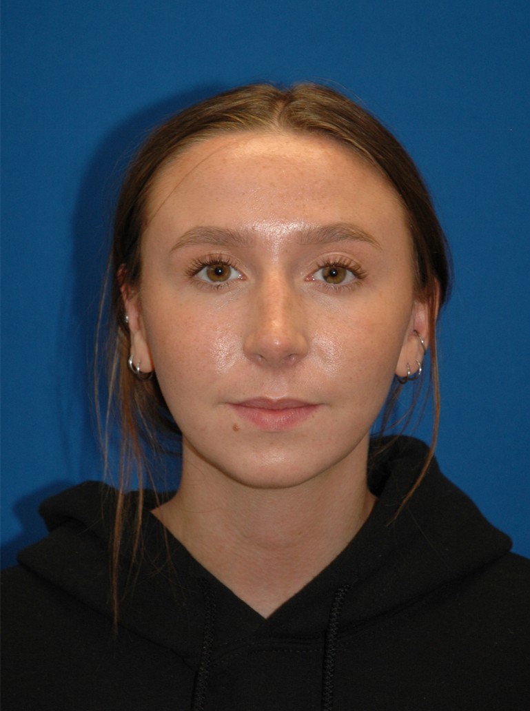 Rhinoplasty — after (frontal)