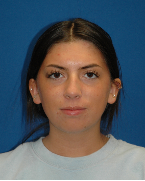 Chin implant — frontal view, before