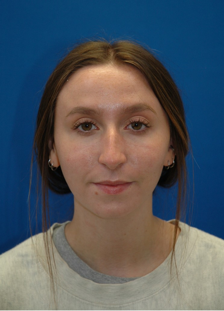 Rhinoplasty — before (frontal)