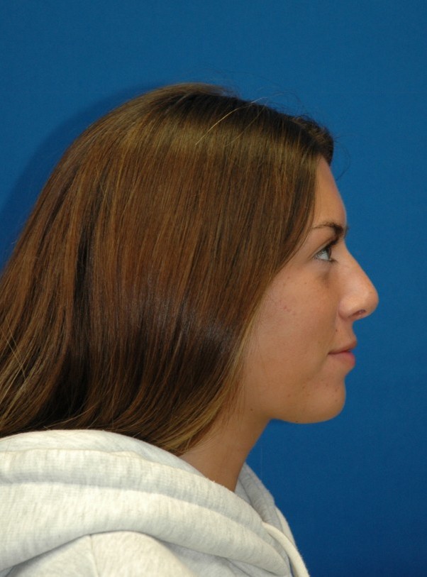 Chin implant — lateral view, after