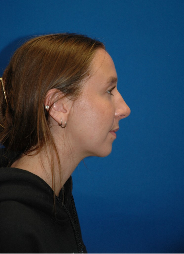 Rhinoplasty — after (profile)