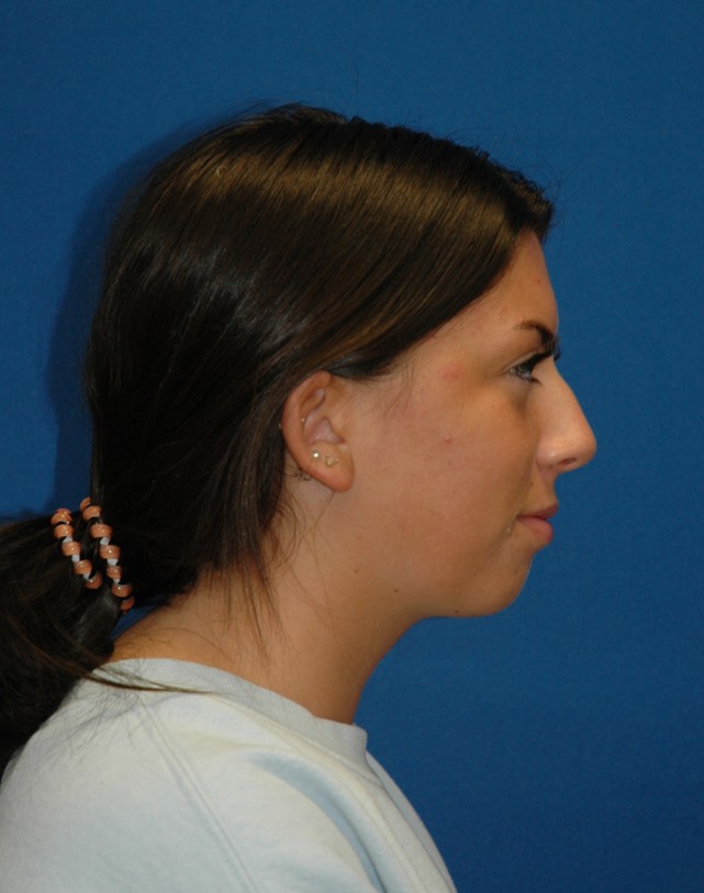 Chin implant — lateral view, before