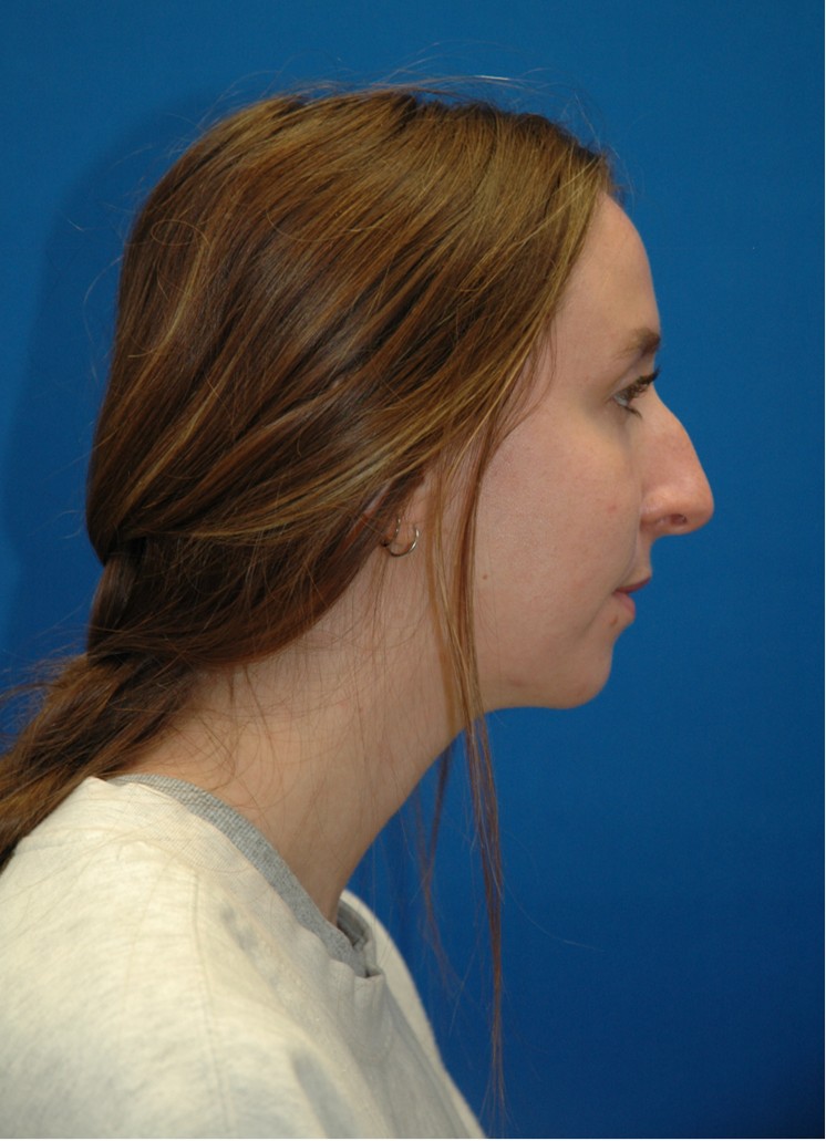 Rhinoplasty — before (profile)