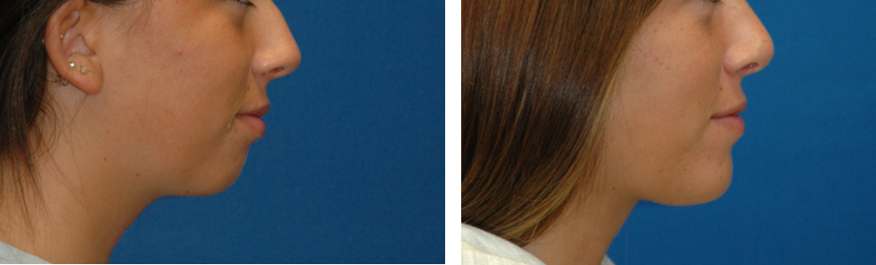 Chin implant — lateral view (together)