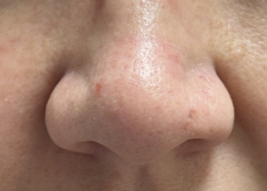 Lesion — after