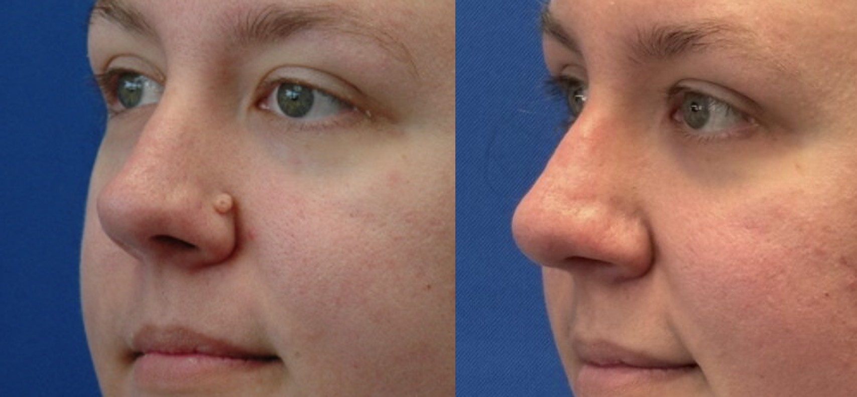 Lesion — before and after (combined image)