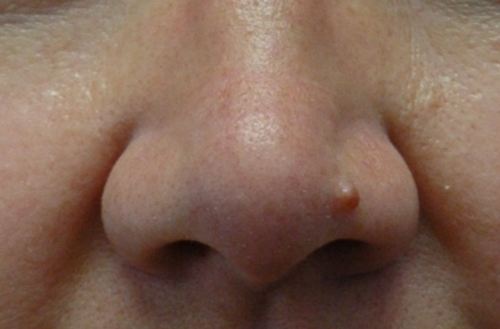 Lesion — before