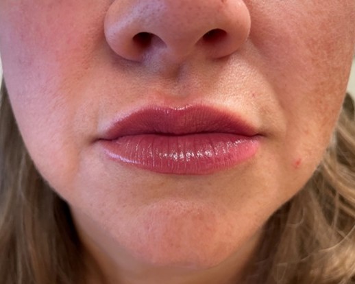 Lip filler — after