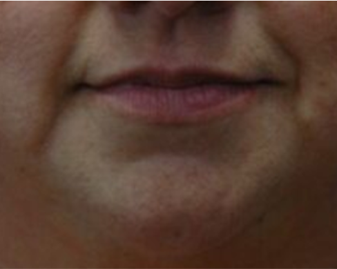 Lip filler — before
