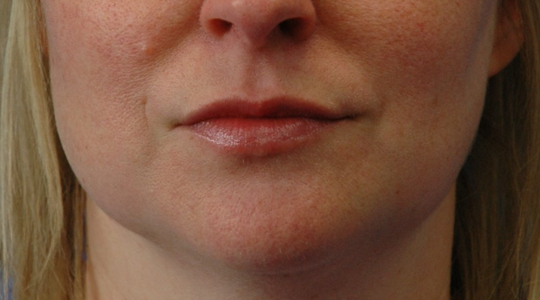 Lips — after (set 2)