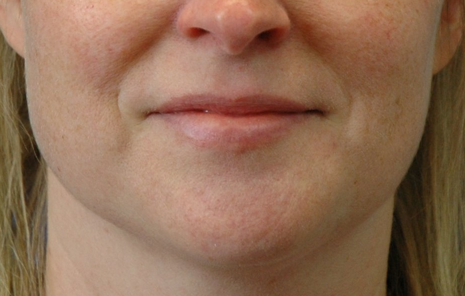 Lips — before (set 2)