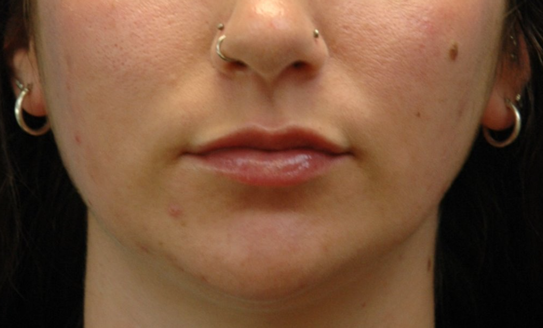 Lips — after (set 3)