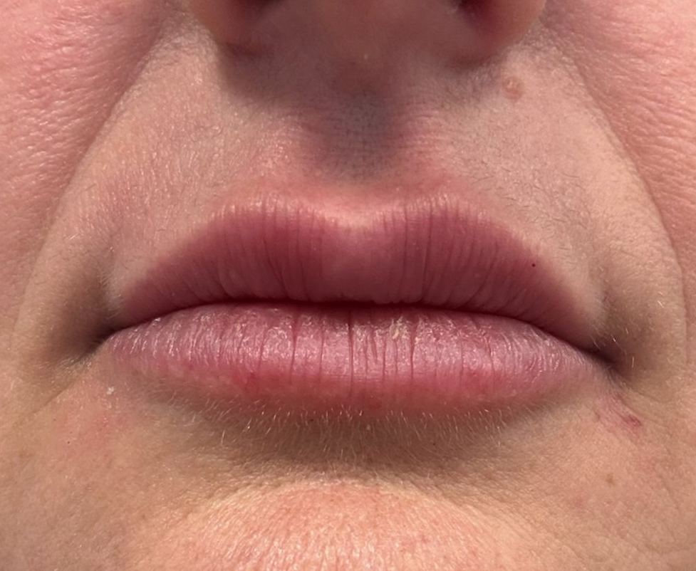 Lips — after
