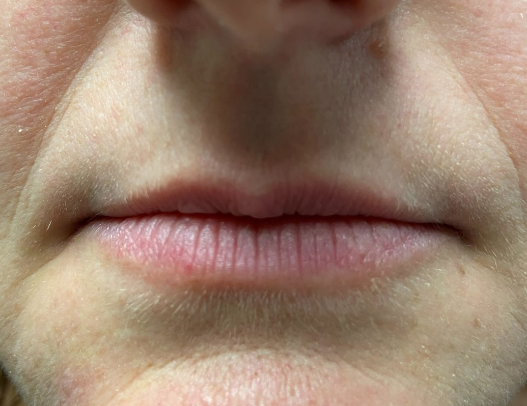 Lips — before