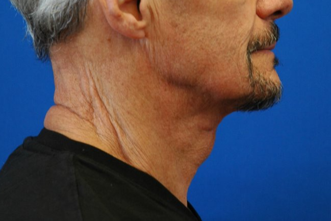 Neck — after