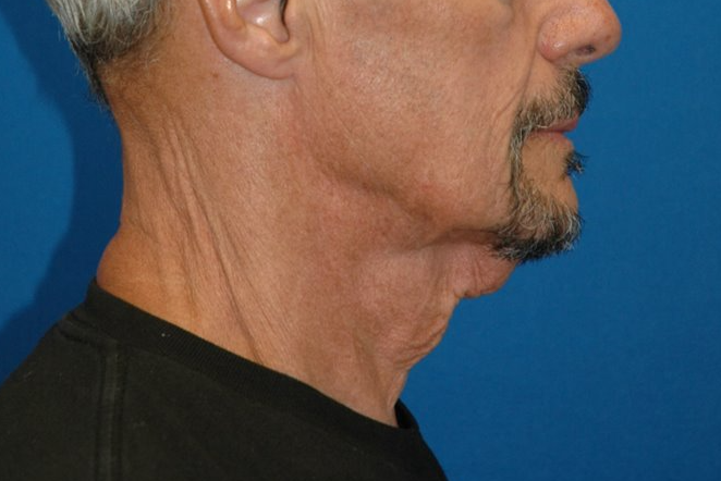 Neck — before