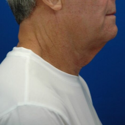 Neck lift — before (lateral)