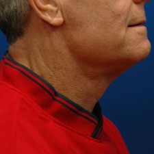 Neck lift — after (lateral)