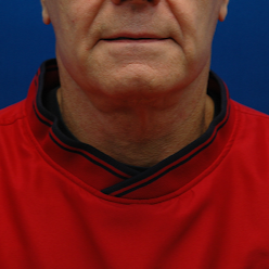 Neck lift — after (frontal)