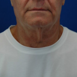 Neck lift — before (frontal)