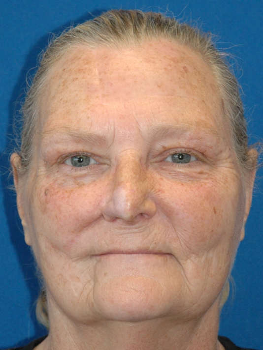Nose reconstruction — after