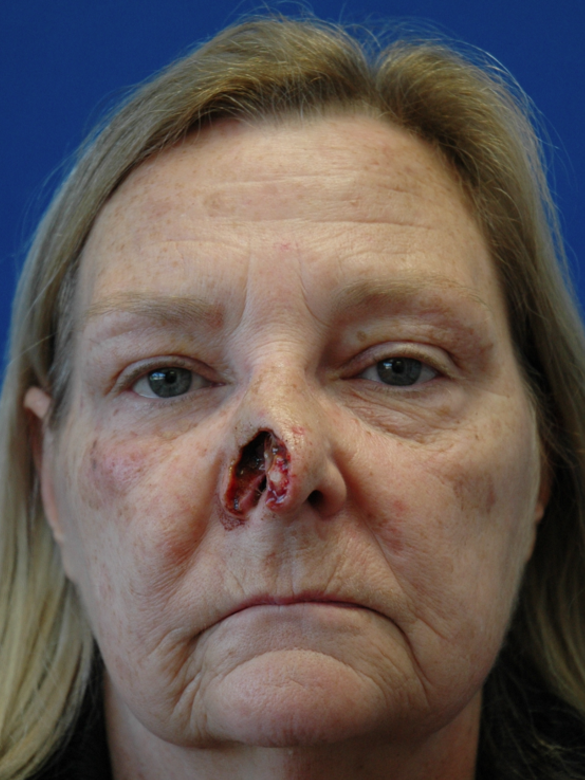 Nose reconstruction — before