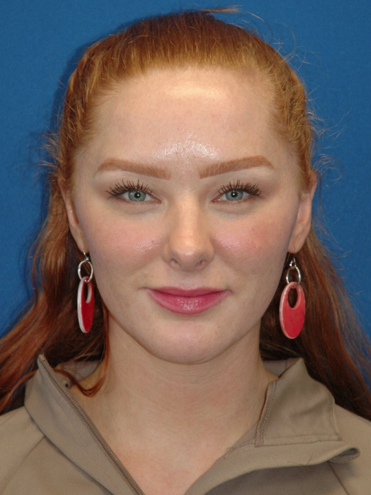 Rhinoplasty — after (frontal)